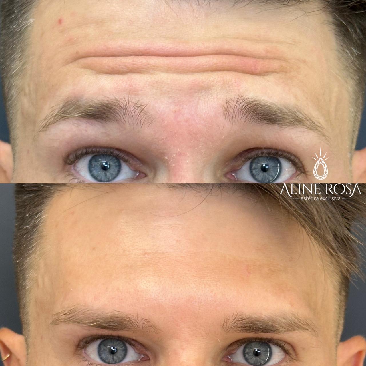 Botox Terço Superior Masculino